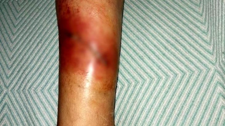 Hatay'da sokak köpeklerinin saldırısına uğrayan kadın yaralandı