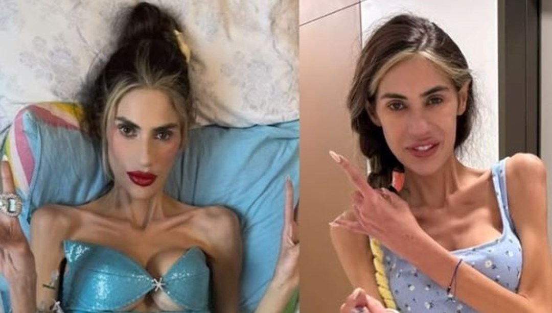 Nihal Candan Hayatını Kaybetti: Anoreksiya Nervoza ile Mücadelesi Son Buldu