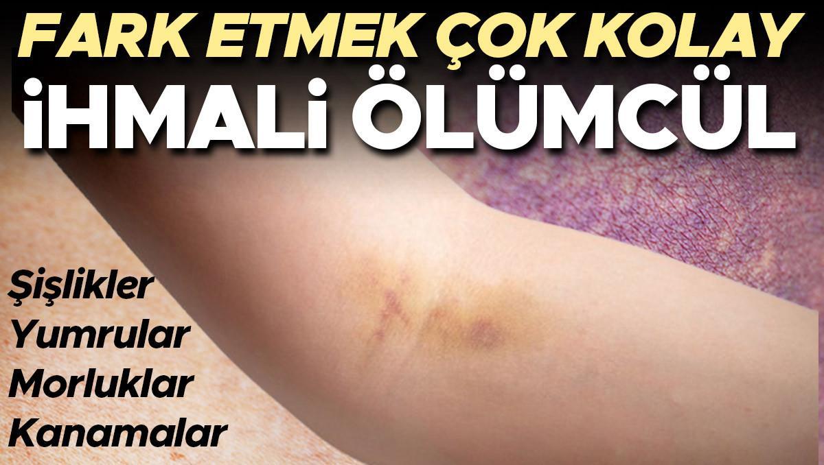Yumrular Sislikler Kanamalar Ihmal Ederseniz Hayatinizi Tehdit Eder