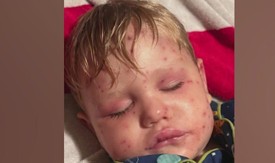 Georgia Boy Stung Over 150 Times by Yellowjackets: A Family’s