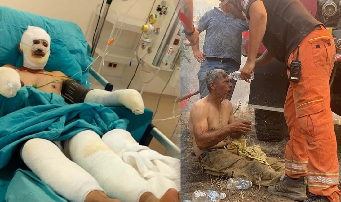 Orman Yangınında Yaralanan İşçi Kader Dereli’nin Tedavisi Devam Ediyor Yangın