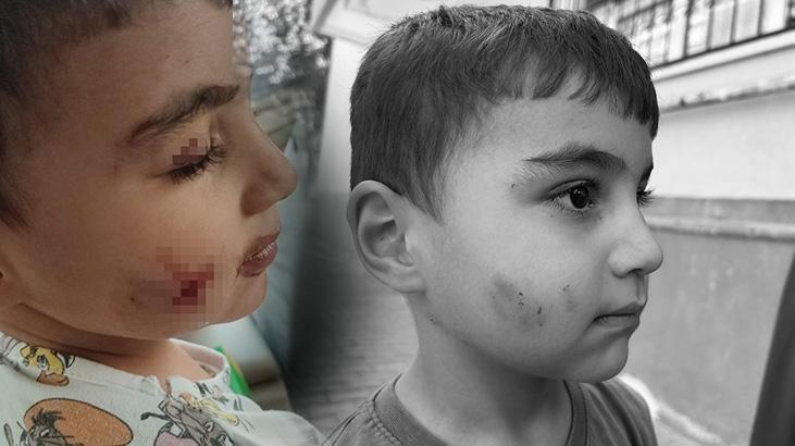 Sincan’da Şok Olay: Bir Çocuğu Lağım Faresi Isırdı Lağım Faresinin