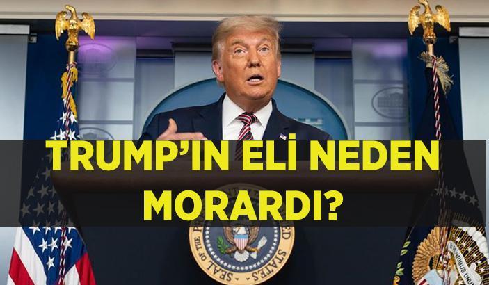 Donald Trump’ın Eli Neden Morardı? Trump’ın Sağlık Durumu Üzerine Açıklamalar
