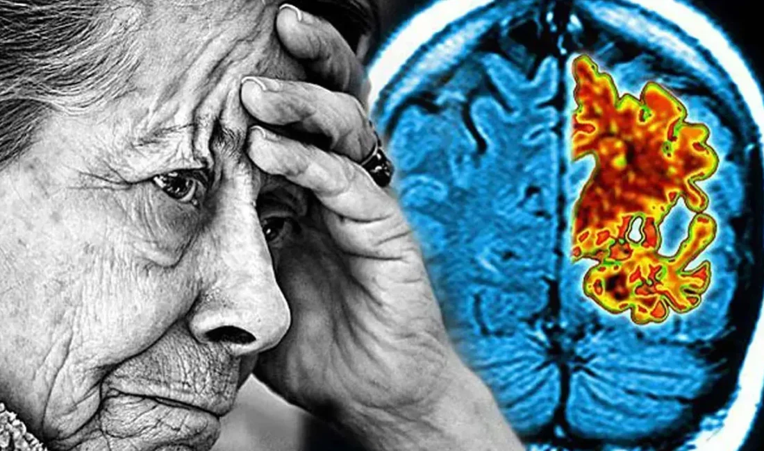 Kadınlar ve Alzheimer: Neden Daha Fazla Risk Altındalar? Alzheimer Nedir?