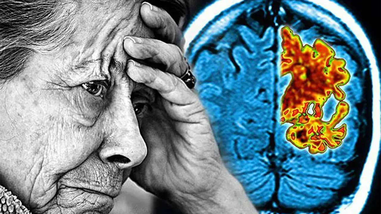 Alzheimer Riskinde Kadinlar Onde Erken Teshis ve Diyet Onerileri.webp