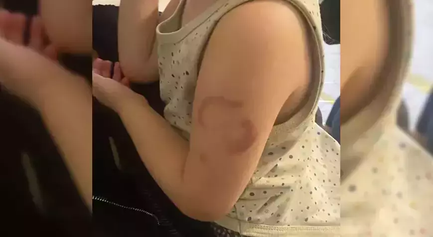 Edirne’deki Kreşte Öğretmen İddiası: 3 Yaşındaki Kız Isırıldı mı? Olayın