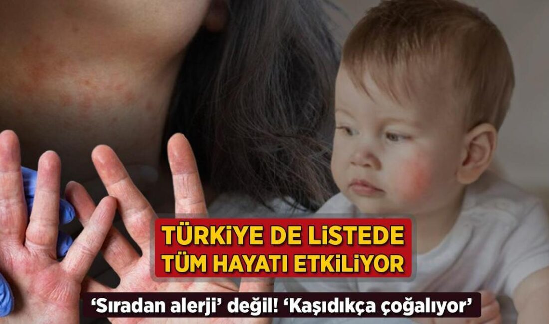 Atopik Dermatit: Yaşam Kalitesini Düşüren Kronik Cilt Hastalığı Atopik dermatit,