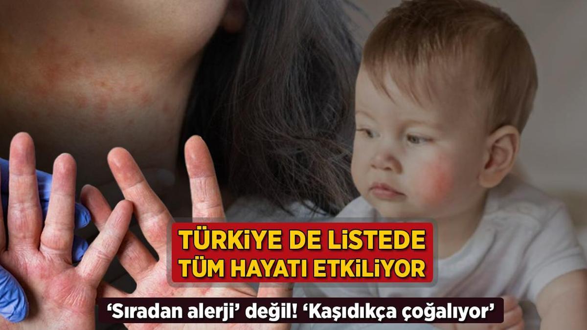 Atopik Dermatit: Yaşam Kalitesini Düşüren Kronik Cilt Hastalığı Atopik dermatit,