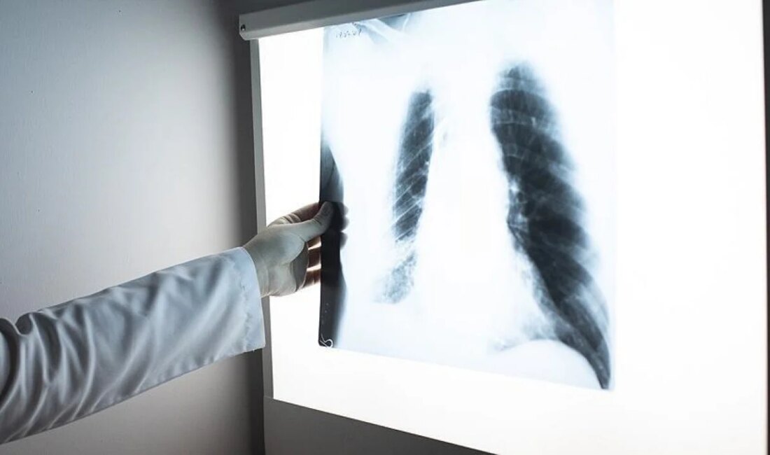 Tüberküloz: Verem Hastalığına Dikkat! Tüberküloz Nedir? Tüberküloz, halk arasında bilinen