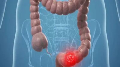 Kolorektal Kanser: Belirtileri ve Tanı Yöntemleri Kolorektal Kanserin Gelişimi ve