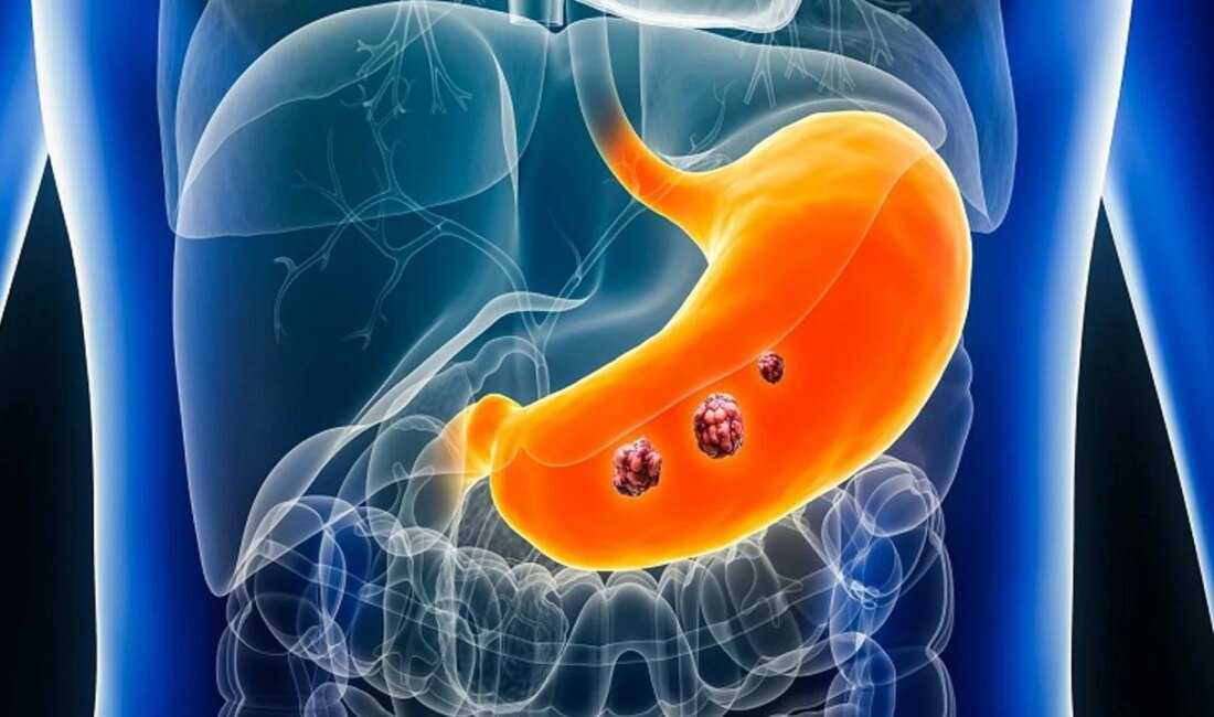 Mide Kanseri: Risk Faktörleri ve Erken Teşhis Yöntemleri Mide Kanseri