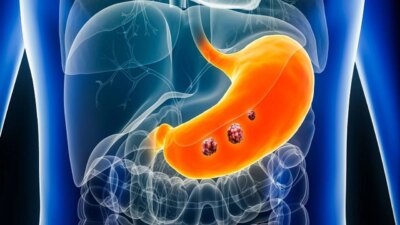 Mide Kanseri: Risk Faktörleri ve Erken Teşhis Yöntemleri Mide Kanseri